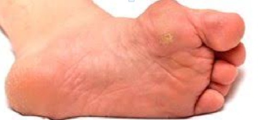 Bunions and Corns – caused by misalignment and pressure points.