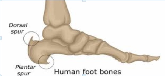 Heel Spurs – calcium build-up on the heel causing sharp pain.