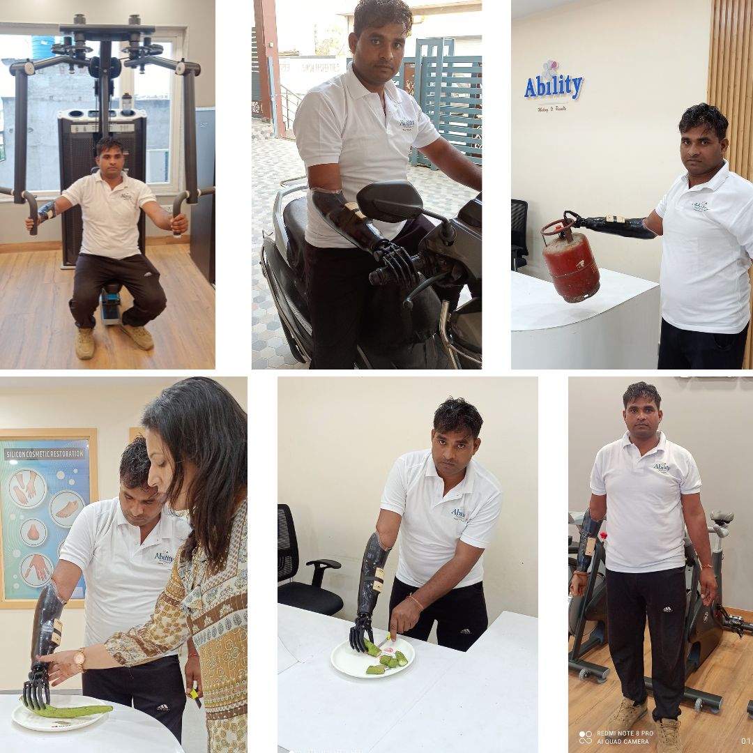 New myoelectric hand in India