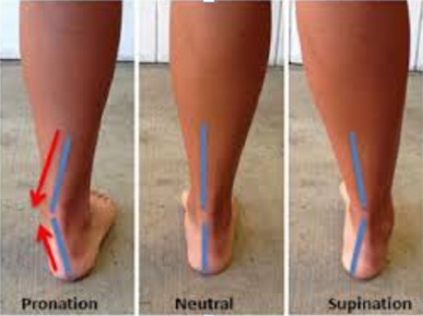 Overpronation or Supination – abnormal foot mechanics leading to pain in knees, hips, and back.