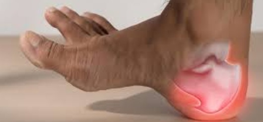 Plantar Fasciitis – heel pain caused by inflammation of the tissue band under the foot.