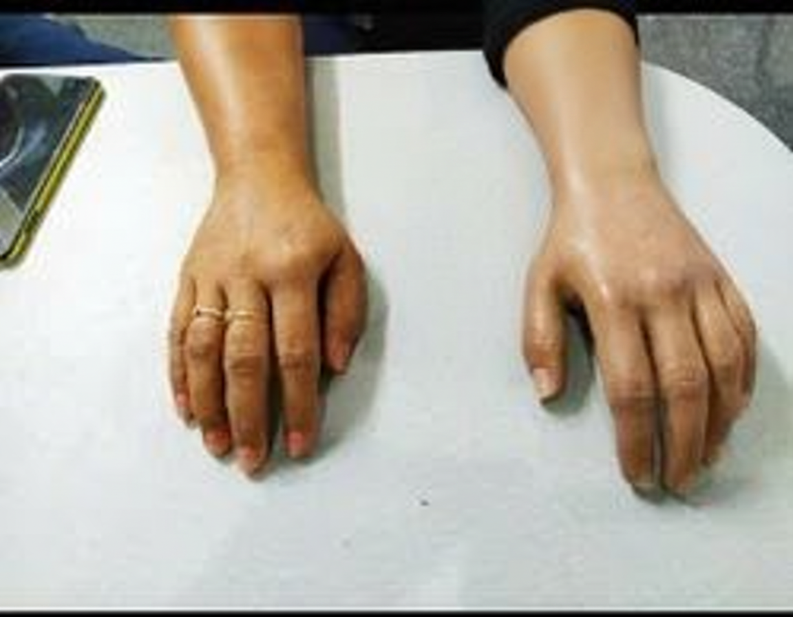 Artificial Hand & Prosthetic Hand Solutions